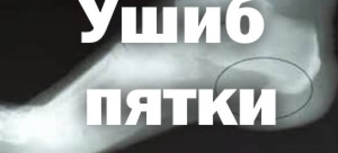 Ударил пятку больно наступать как лечить