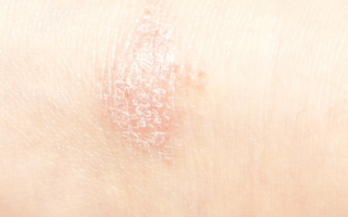 Покраснение и шелушение кожи на ногах