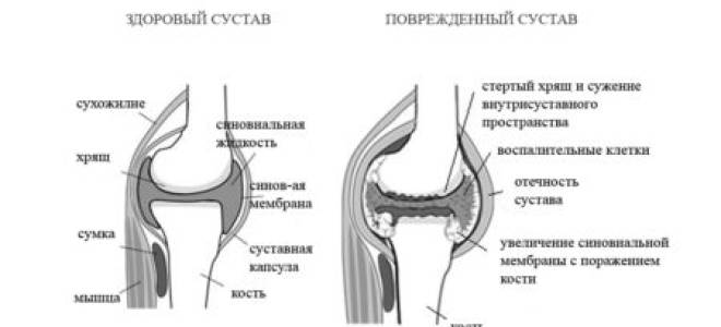 Диагноз ревматоидный артрит