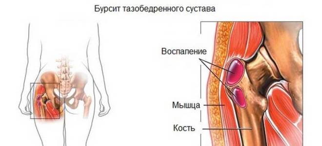 Болит кость таза слева