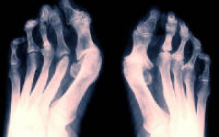 Лечение артрита стопы ног медикаменты