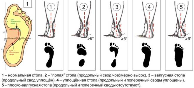 Третья степень плоскостопия сколько градусов