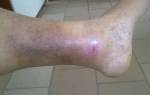 Воспаление вены на ноге лечение фото