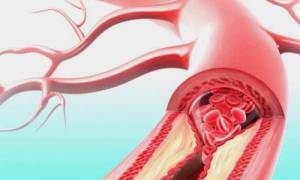 Тромбоз лучевой артерии
