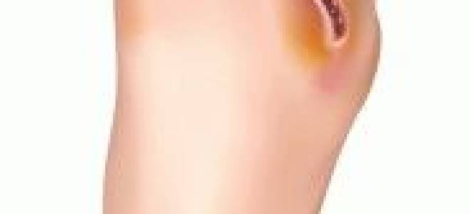 Лечение ран при сахарном диабете на ногах