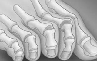 Искривление второго пальца на ноге