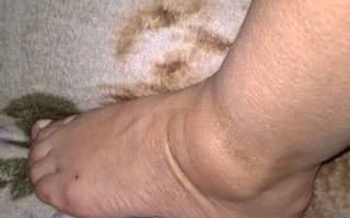 Болит нога внизу где косточка