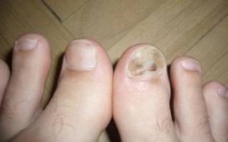 Опухоль на пальце ноги возле ногтя