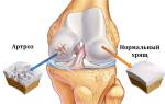 Болит коленный сустав как облегчить боль
