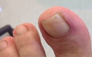 Воспаление ногтевого ложа
