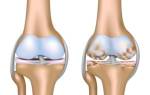 История болезни артроз коленного сустава