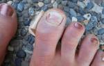 Расслоение ногтей на ногах причина и лечение