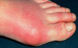 Лечение рожистого воспаления на ноге мазями