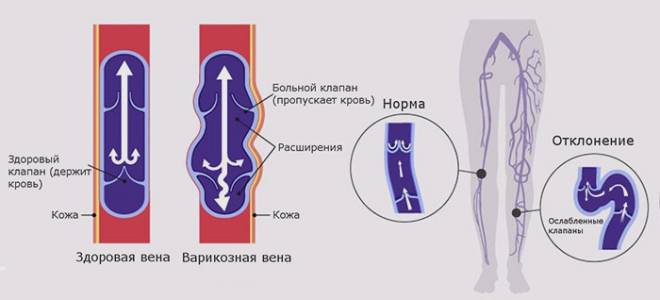 Какие упражнения делать при варикозе ног