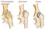 Боль в тазобедренном суставе отдающая в колено