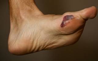Кровяная мозоль на пальце ноги что делать