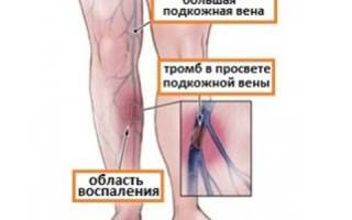 Где образуются тромбы в ногах