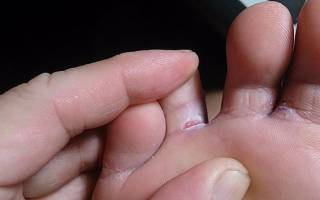 Трещина пальца на ноге симптомы фото