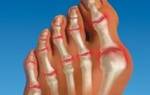 Деформация пальцев на ногах причины и лечение