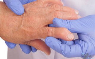 Ревматоидный артрит профилактика и лечение