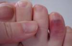 Симптомы перелома пальца на ноге мизинец