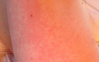 Сыпь на стопе в виде красных точек