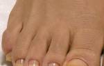 Почему пожелтели ногти на ногах