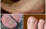 Виды грибков ногтей на ногах