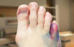 Признаки перелома пальца на ноге мизинца