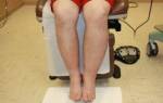 Лимфатический отек ног лечение