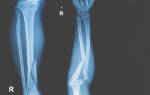 Открытый перелом ноги время восстановления