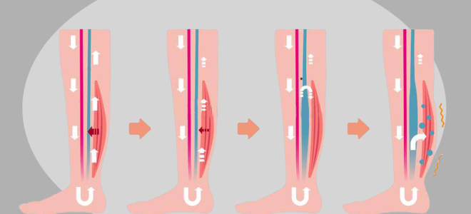 Сильная отечность ног что делать
