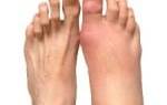Болят мизинцы на ногах при ношении обуви