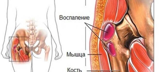 Воспаление суставной сумки тазобедренного сустава