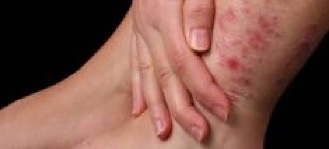 Как убрать натоптыши на пальцах ног