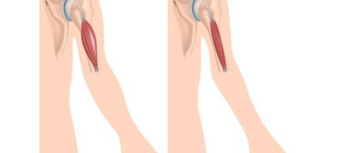 Можно ли восстановить атрофированные мышцы