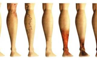 Варикозное расширение вен на ногах симптомы