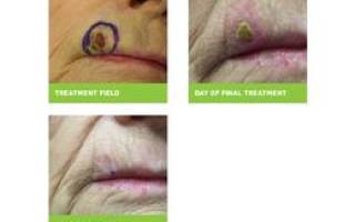 Короткофокусная рентгенотерапия