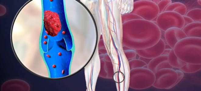 Первые признаки тромбоза