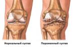 Остеоартроз коленного сустава 1 стадии