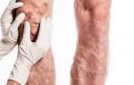 Признаки варикоза ног у мужчин