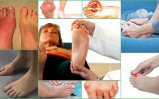 Бывает ли подагра у женщин