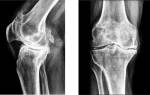 Массаж при артрите коленного сустава видео