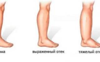 Опухоль на ноге ниже колена фото