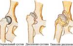 Фиброзная дисплазия малой берцовой кости лечение