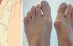 Как лечить шишки на ногах большого пальца