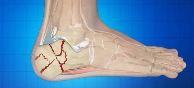 Перелом пятки без смещения срок заживления